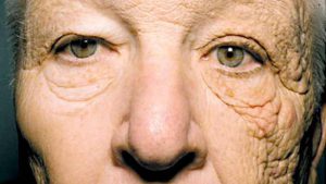 öregedés elleni bőr kezelés